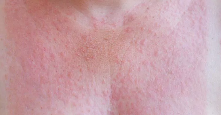 Heb je een zonnesteek? Wat zijn de symptomen van een zonnesteek en is er een behandeling? Tips van dermatoloog Marjolein Leenarts.