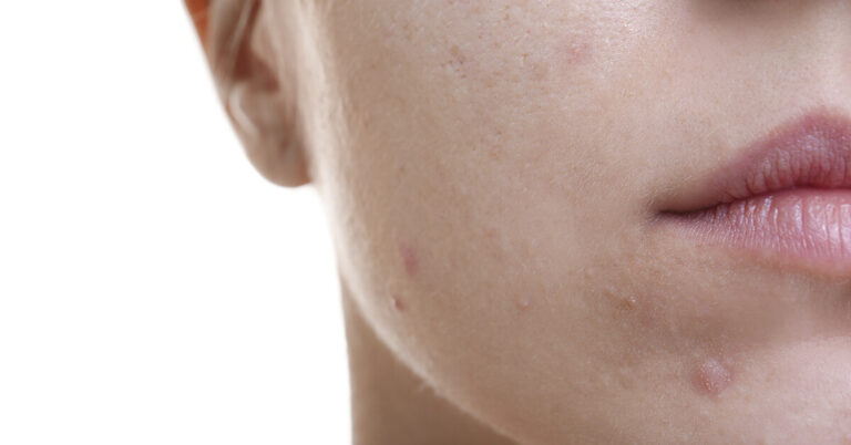 Effectieve huidverzorging voor het verminderen van onzuiverheden