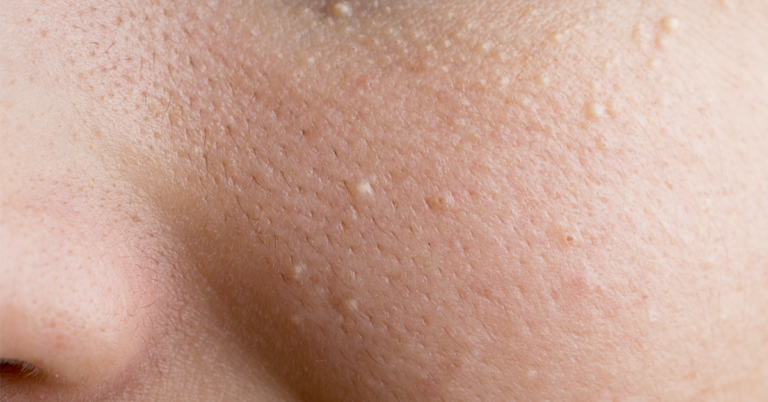 Gerstekorrels op de huid, tips voor behandeling
