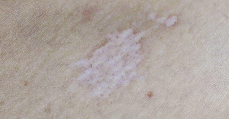 Lichen sclerosus heeft een littekenachtige witte structuur.